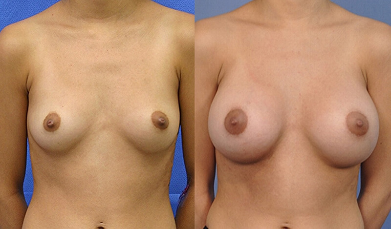 Breast Aug before and after results