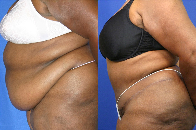 Tummy Tuck patient results
