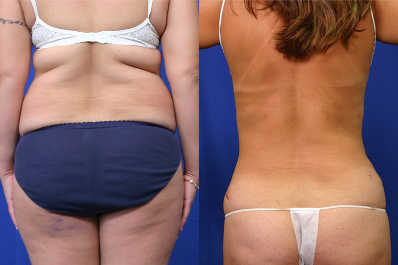 Liposuction patient results