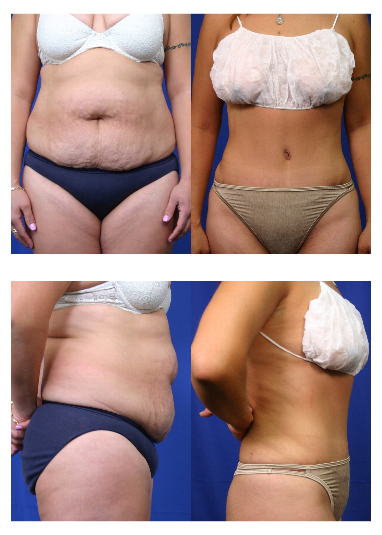 Tummy-Tuck-patient-08 | Before and After Tummy Tuck