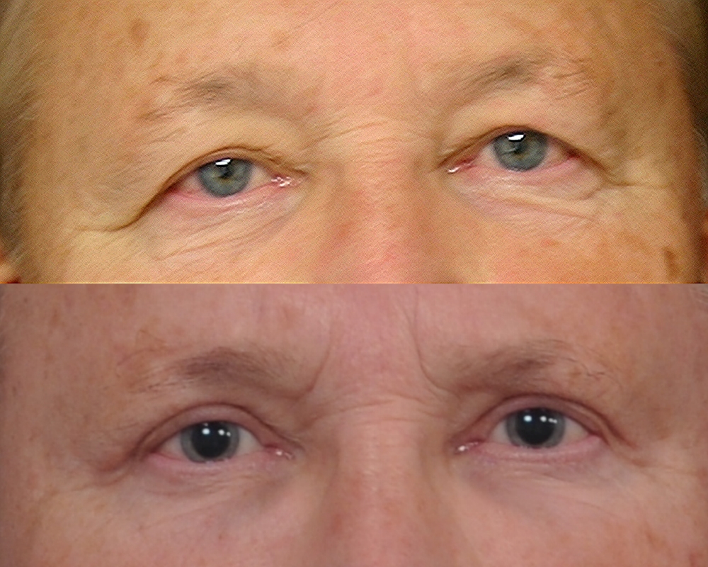 Case--0015 | Before and After Blepharoplasty