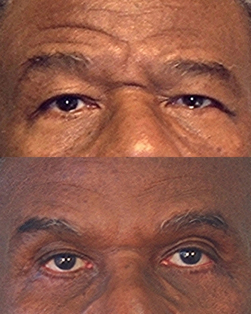Case--0014 | Before and After Blepharoplasty