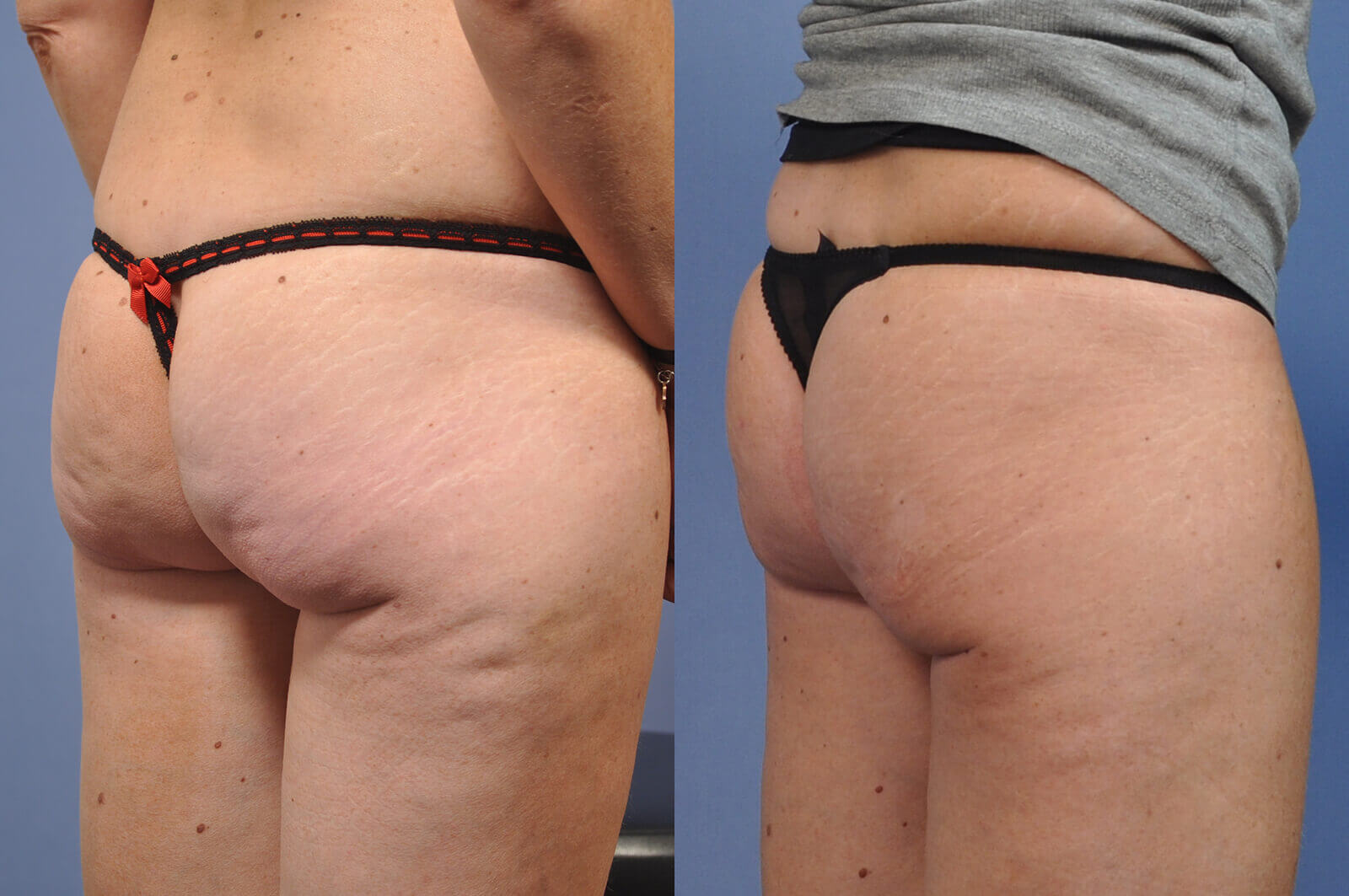 Case--0134 | Before and After Brazilian Butt Lift