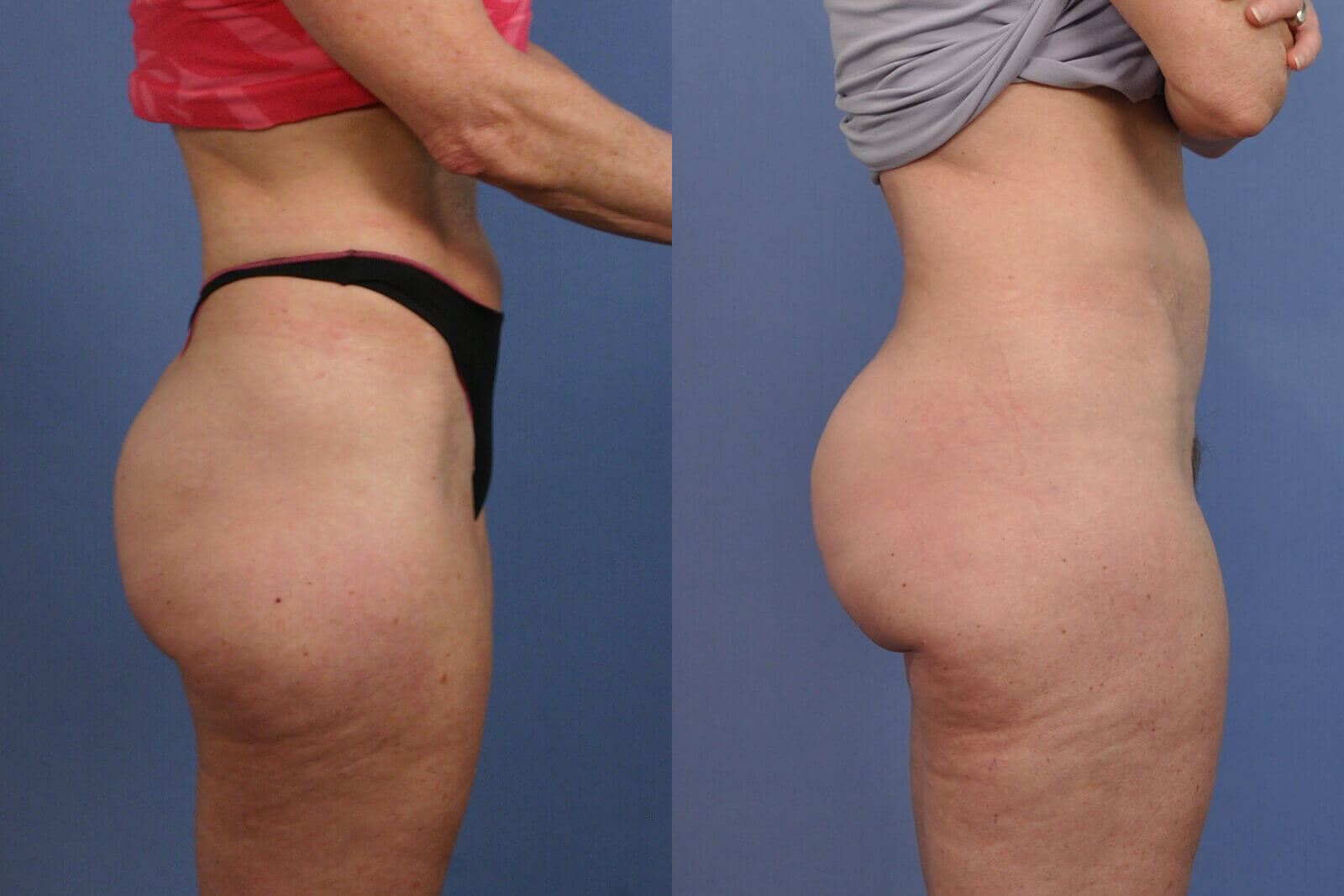 Case--0132 | Before and After Brazilian Butt Lift