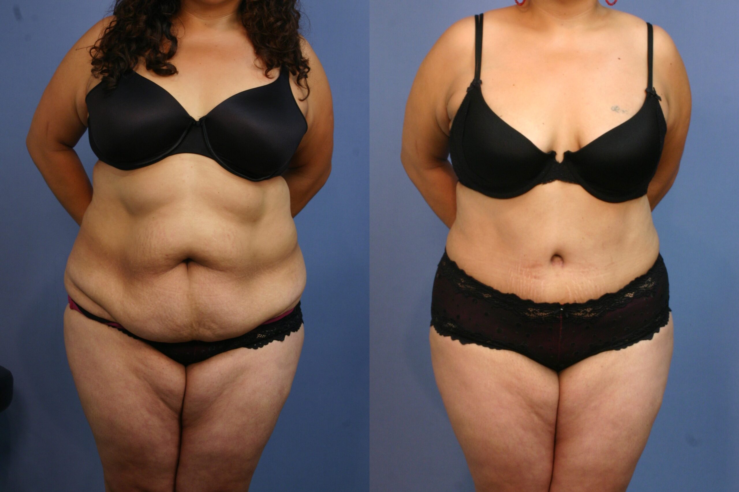 Tummy-Tuck-patient-14 | Before and After Tummy Tuck
