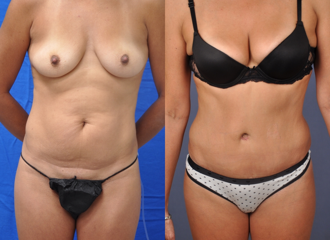 Tummy-Tuck-patient-10 | Before and After Tummy Tuck