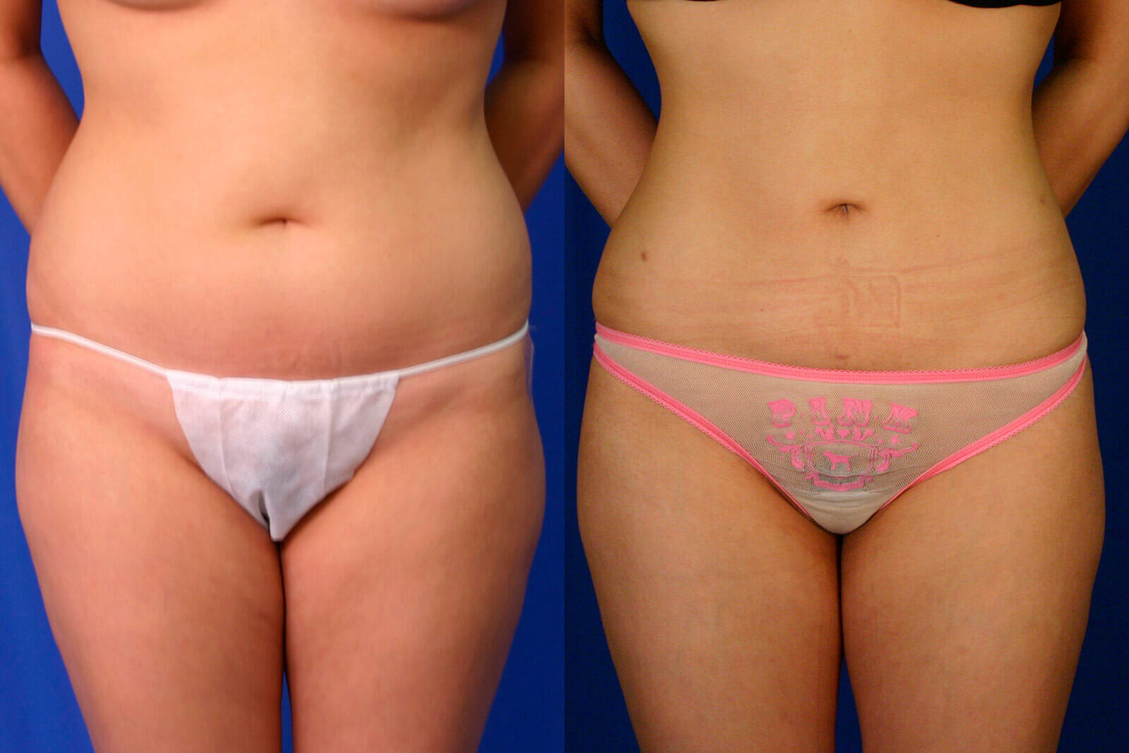 Case--8007 | Before and After Liposuction