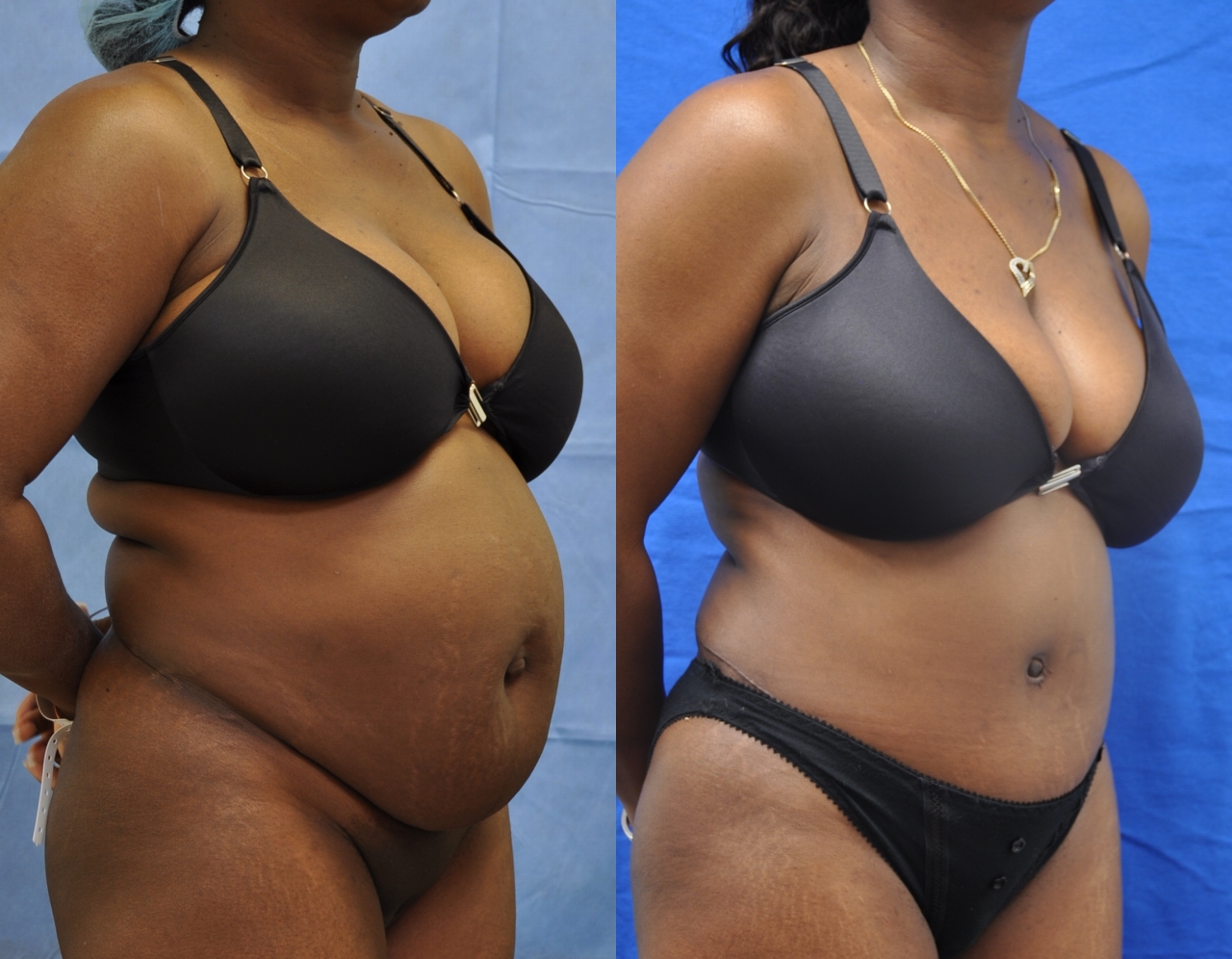 Tummy-Tuck-patient-13 | Before and After Tummy Tuck