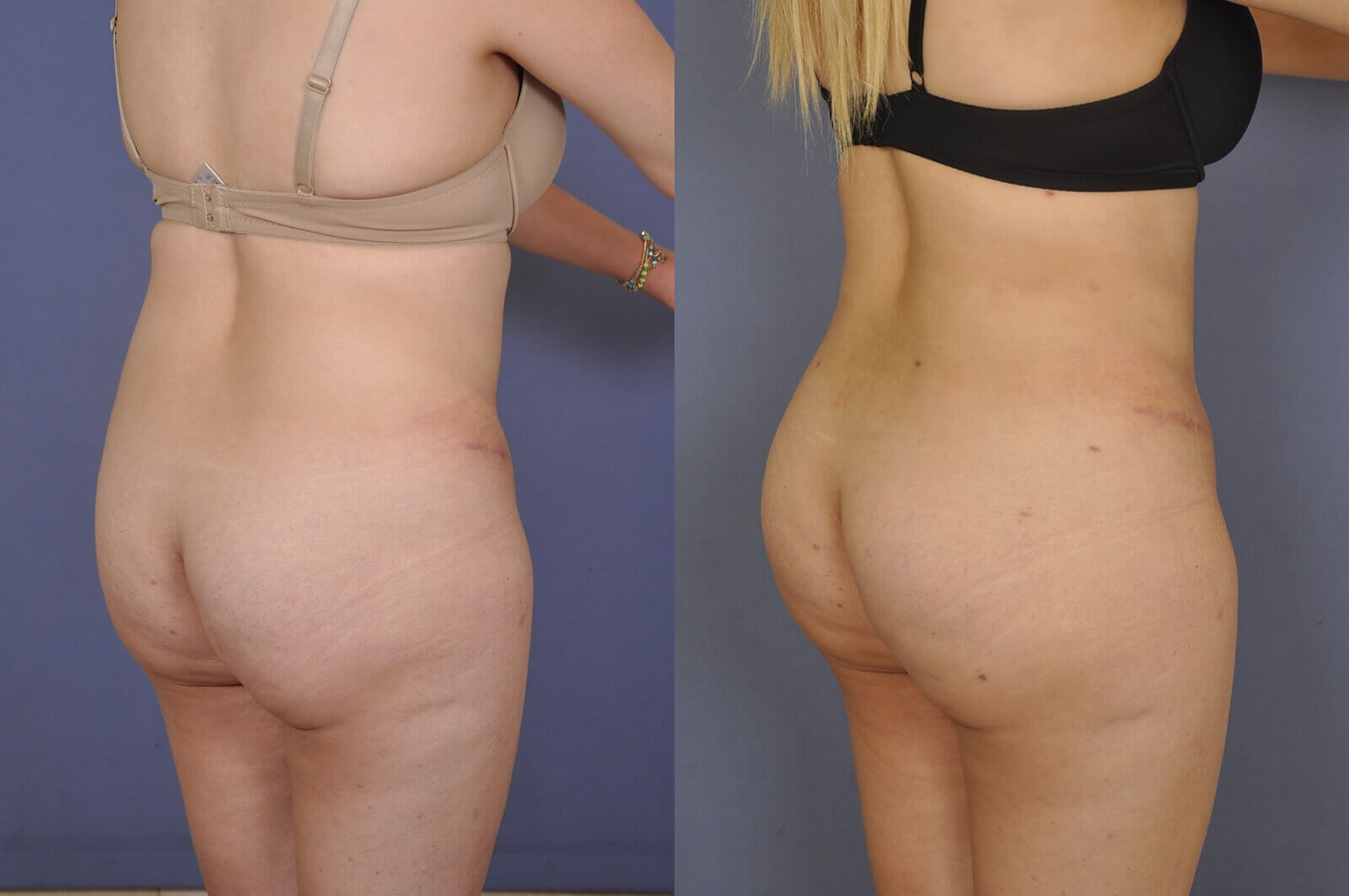 Case--0139 | Before and After Brazilian Butt Lift