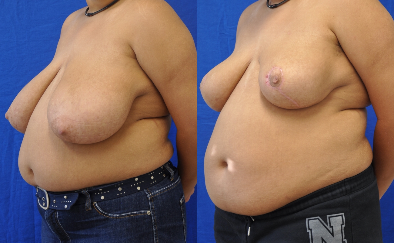Breast-reduction-patient-01 | Before and After Breast Reduction