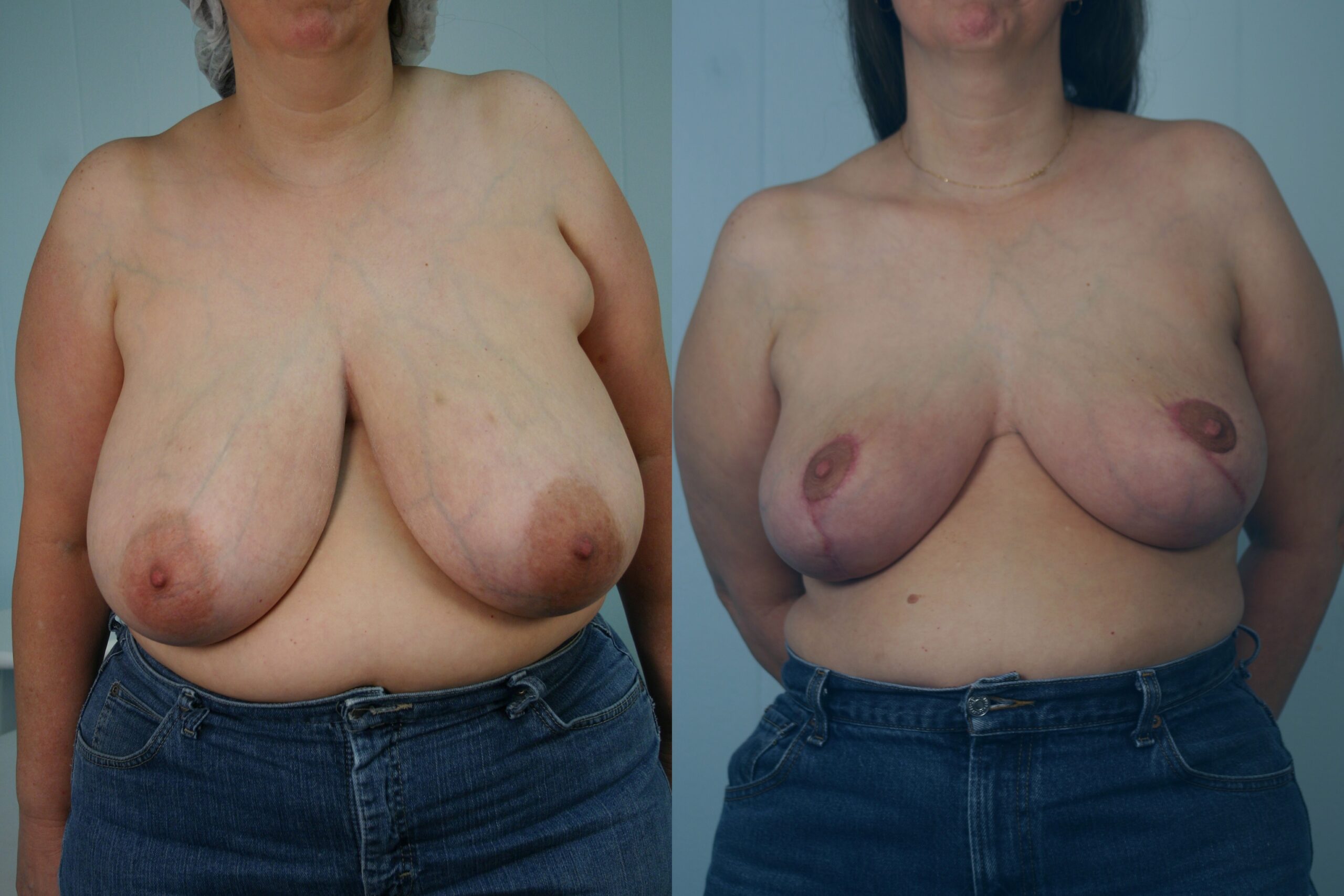 Breast-reduction-patient-02 | Before and After Breast Reduction