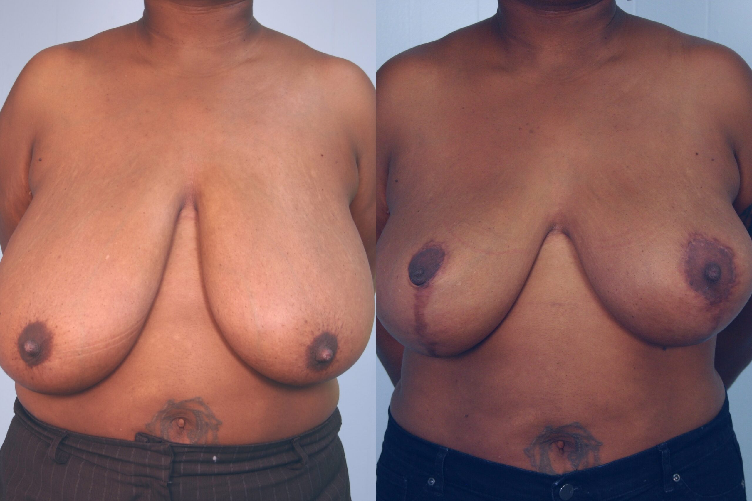 Breast-reduction-patient-03 | Before and After Breast Reduction