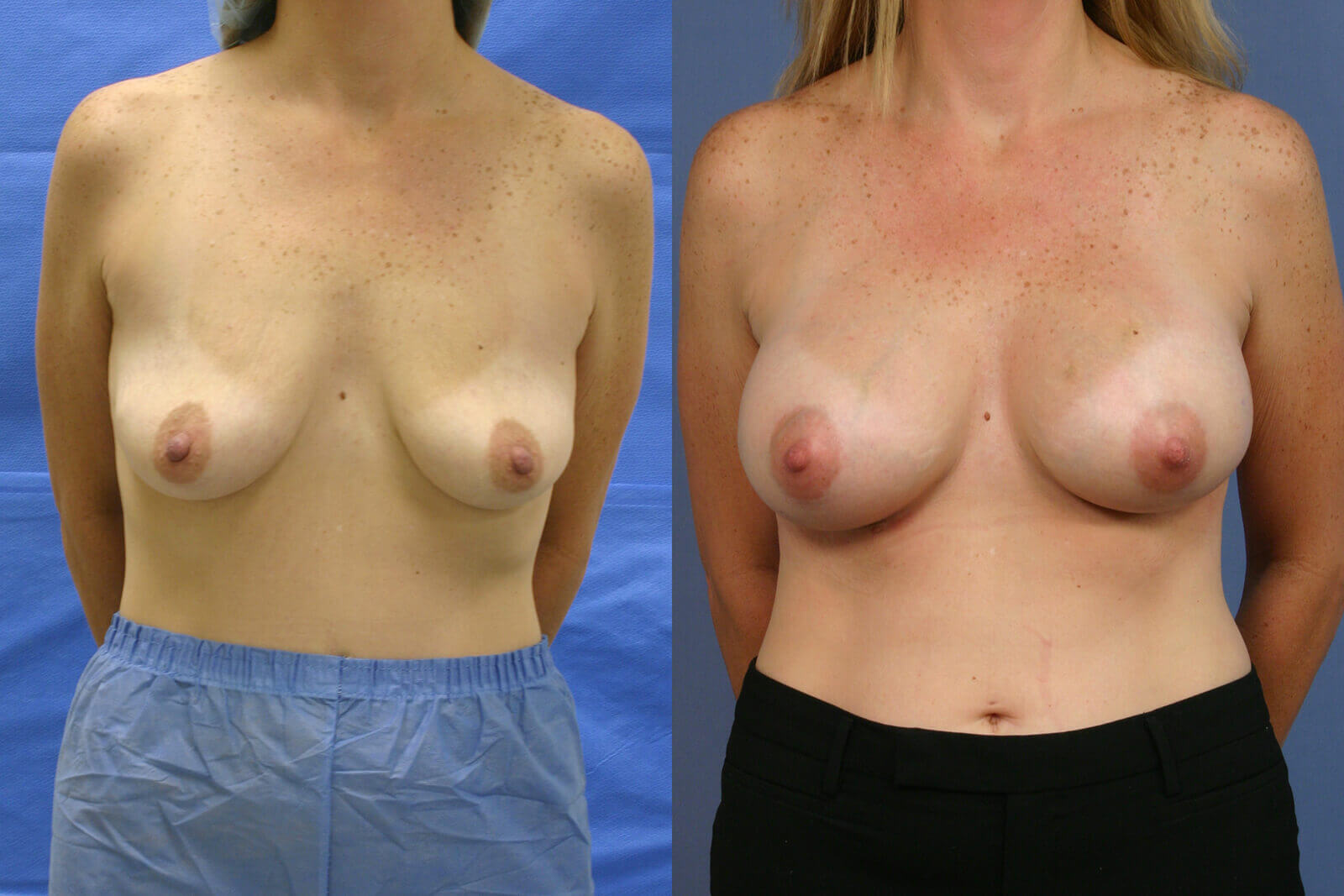 Case--5006 | Before and After Breast Augmentation