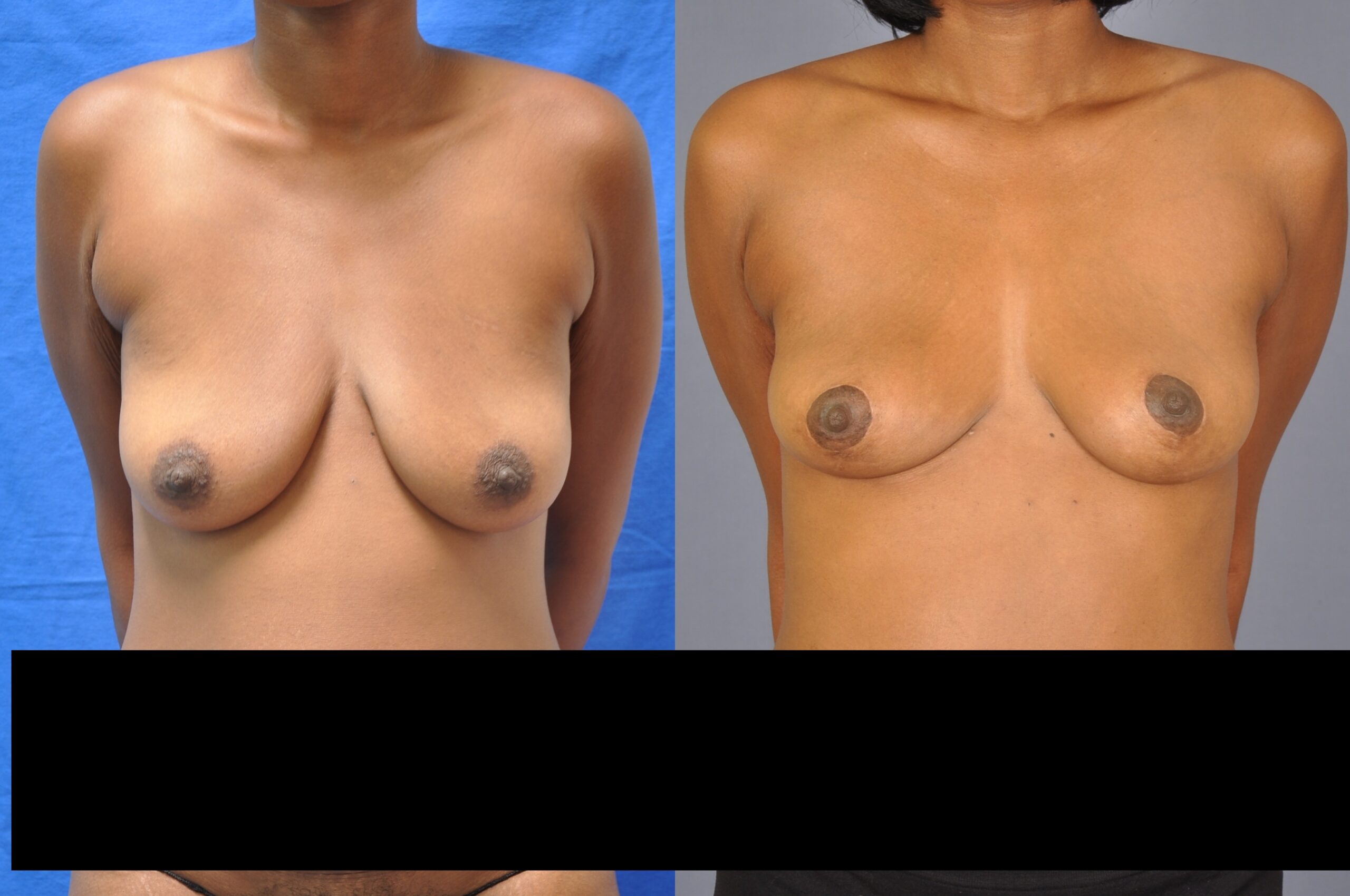 Breast-lift | Before and After Breast Lift