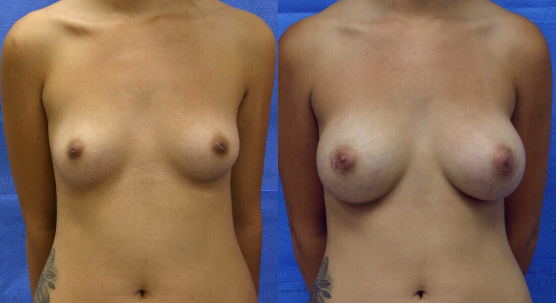 Case--5009 | Before and After Breast Augmentation