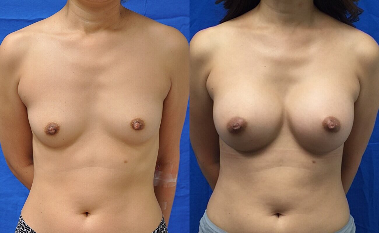 Case--5010 | Before and After Breast Augmentation