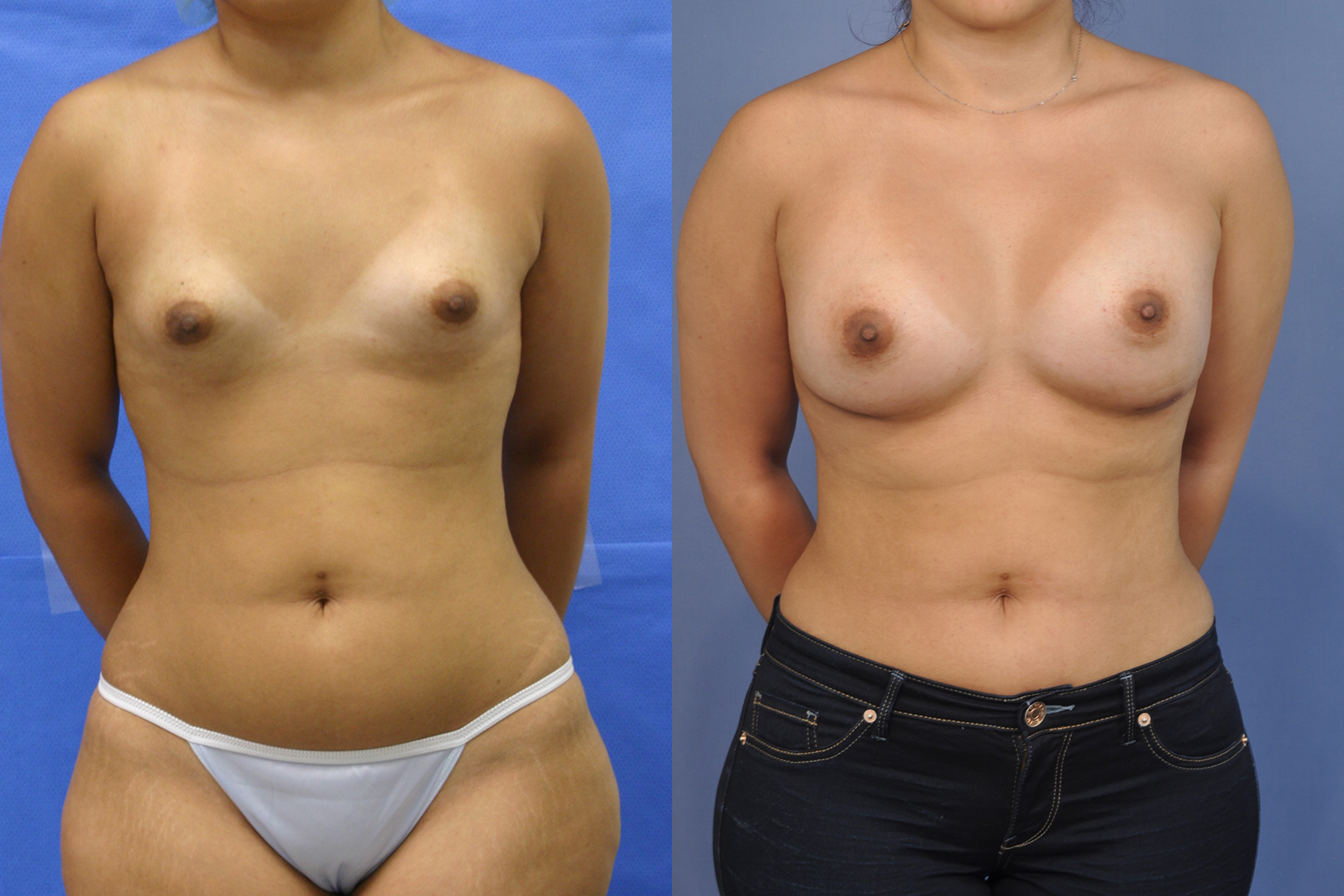 Case--5005 | Before and After Breast Augmentation