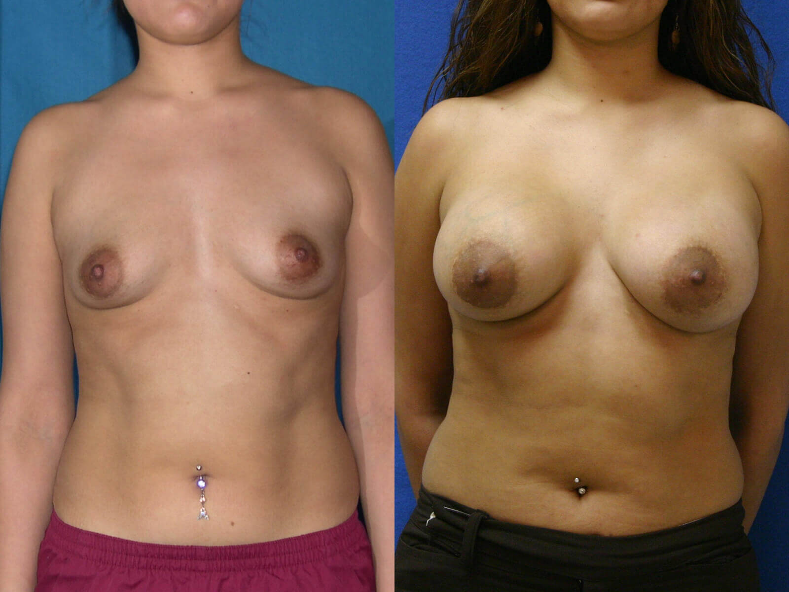 Case--5011 | Before and After Breast Augmentation