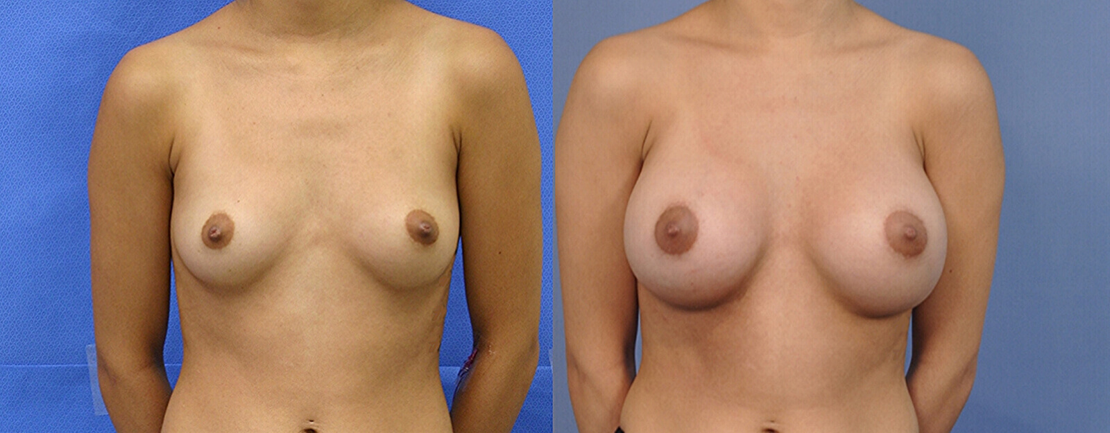 Case--5007 | Before and After Breast Augmentation