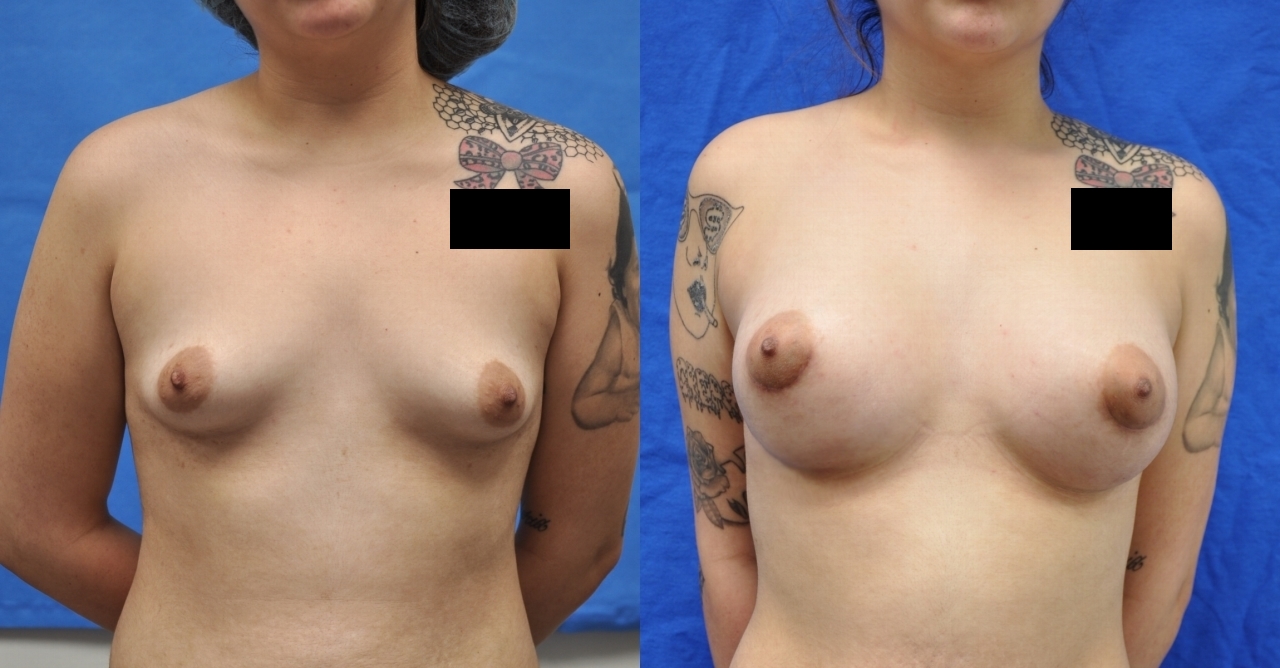 Breast-Augmentation-12 | Before and After Breast Augmentation