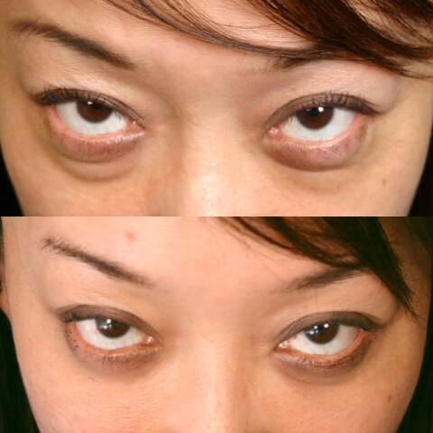 Case--0008 | Before and After Blepharoplasty