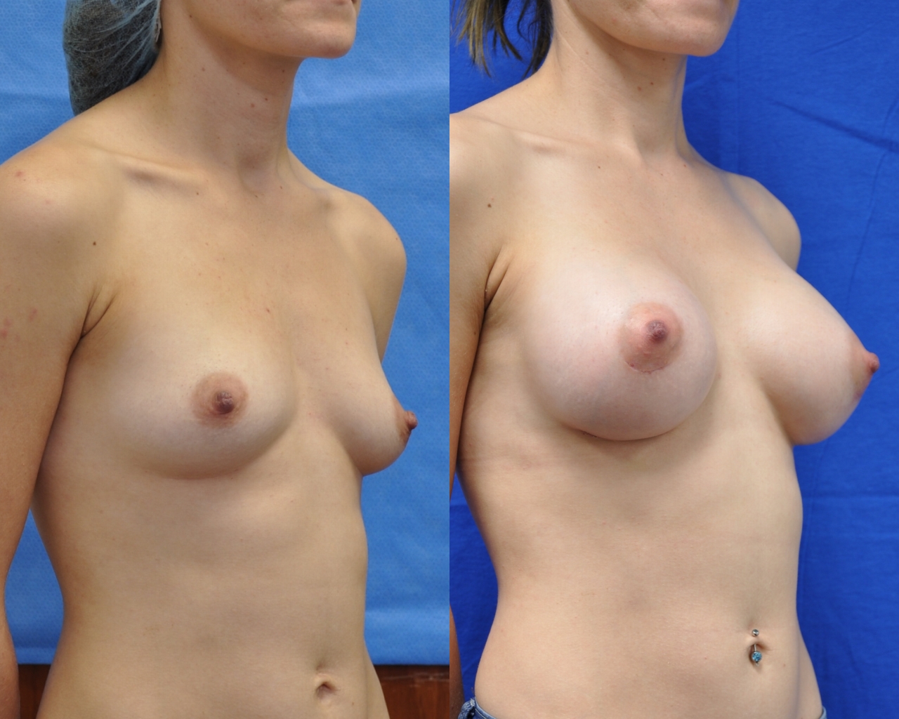 Breast-Augmentation-10 | Before and After Breast Augmentation