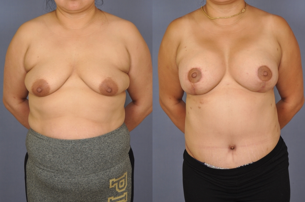 Case--2003 | Before and After Mommy Makeover