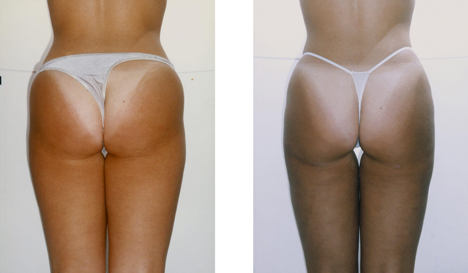 Case--8009 | Before and After Liposuction