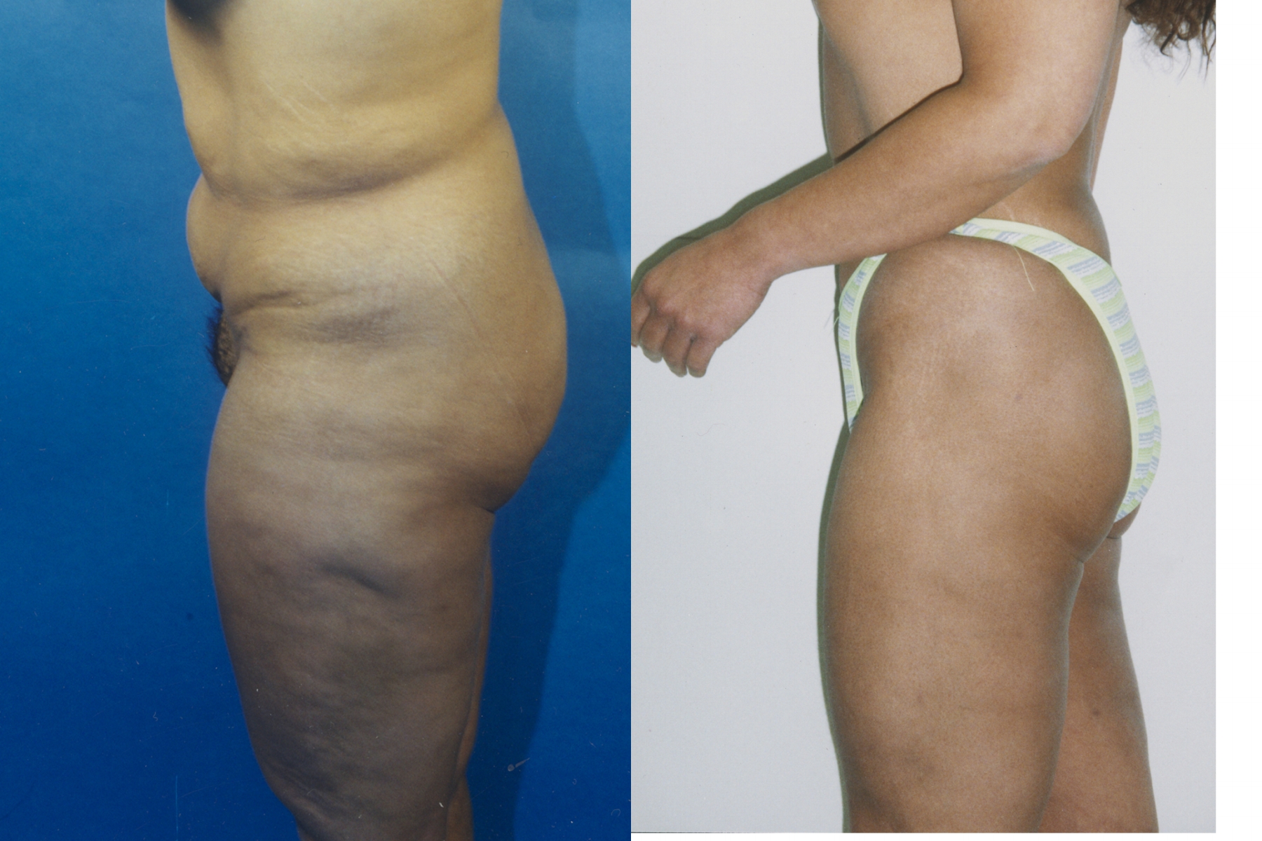 Case--8016 | Before and After Liposuction