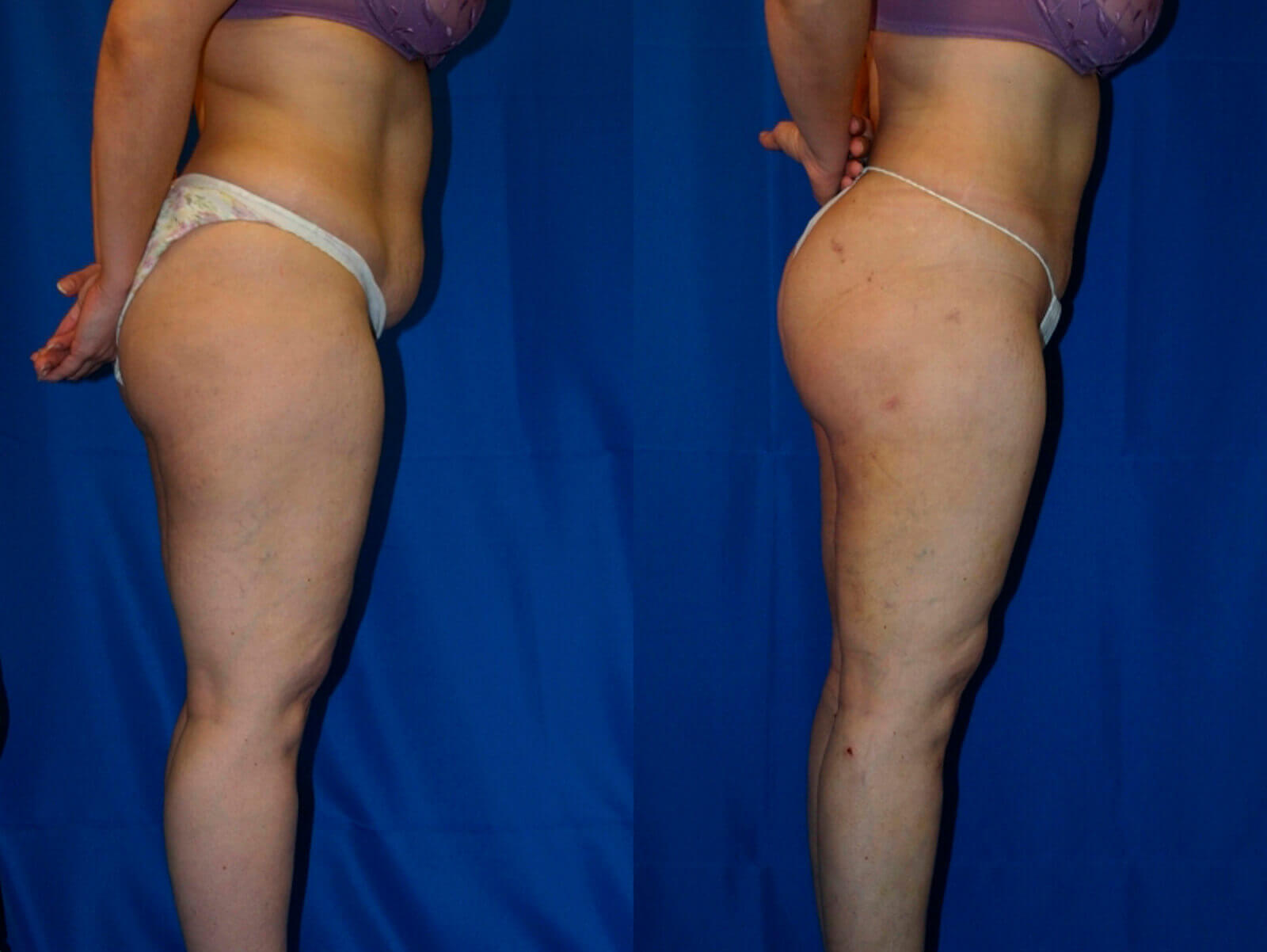Case--8011 | Before and After Liposuction
