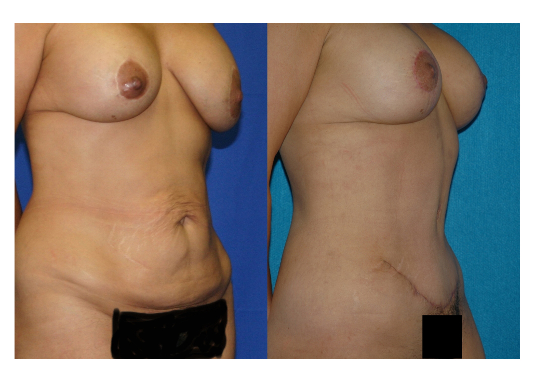 Case--2035 | Before and After Mommy Makeover