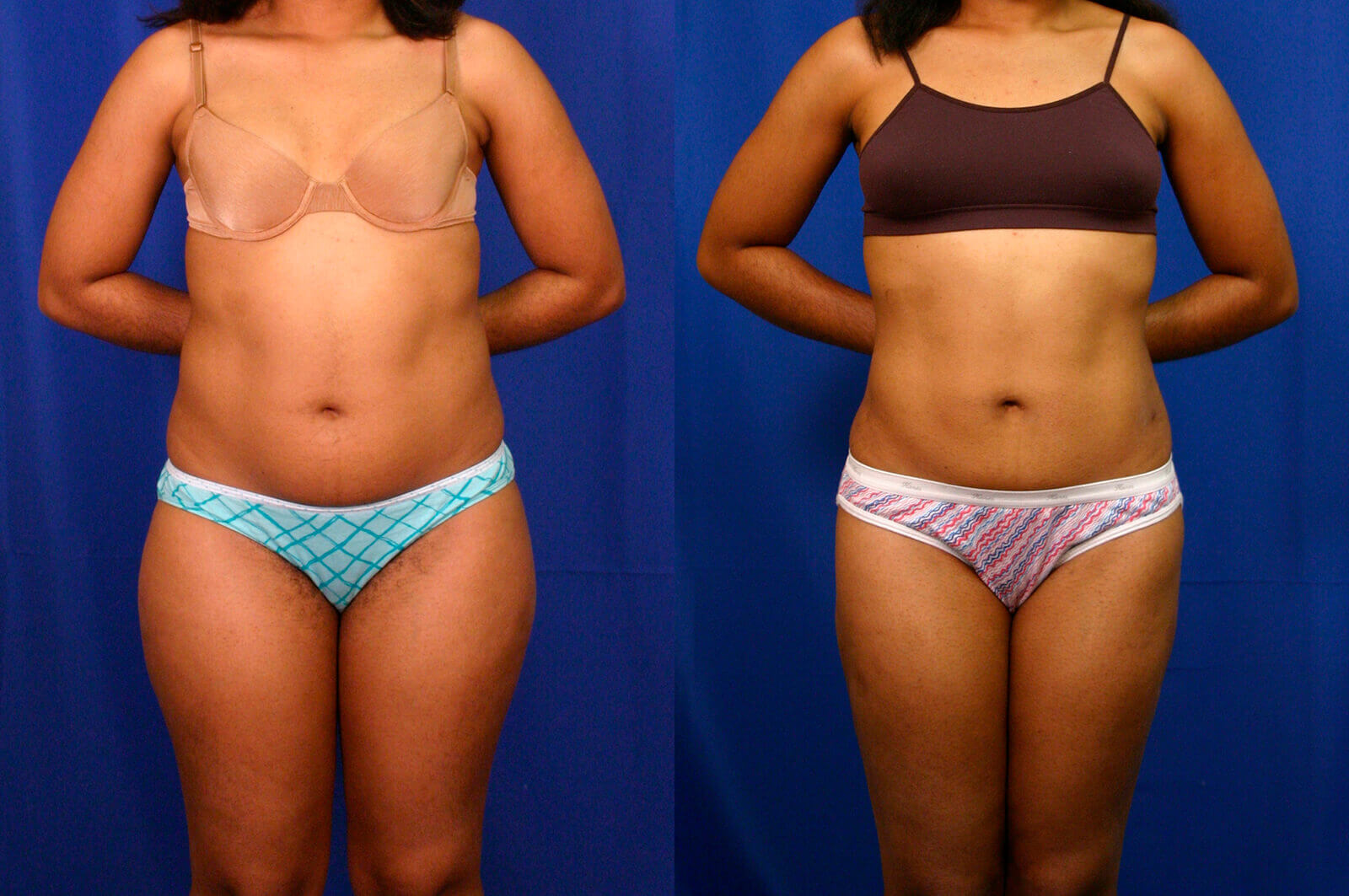 Case--8006 | Before and After Liposuction