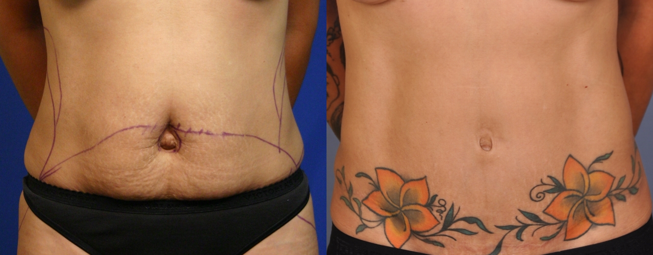 Tummy-Tuck-patient-09 | Before and After Tummy Tuck