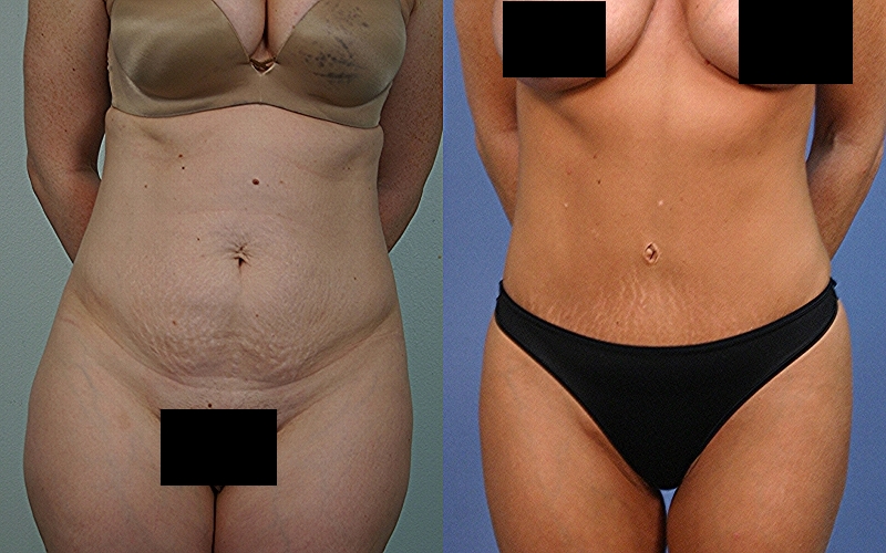 Tummy-Tuck-patient-12 | Before and After Tummy Tuck