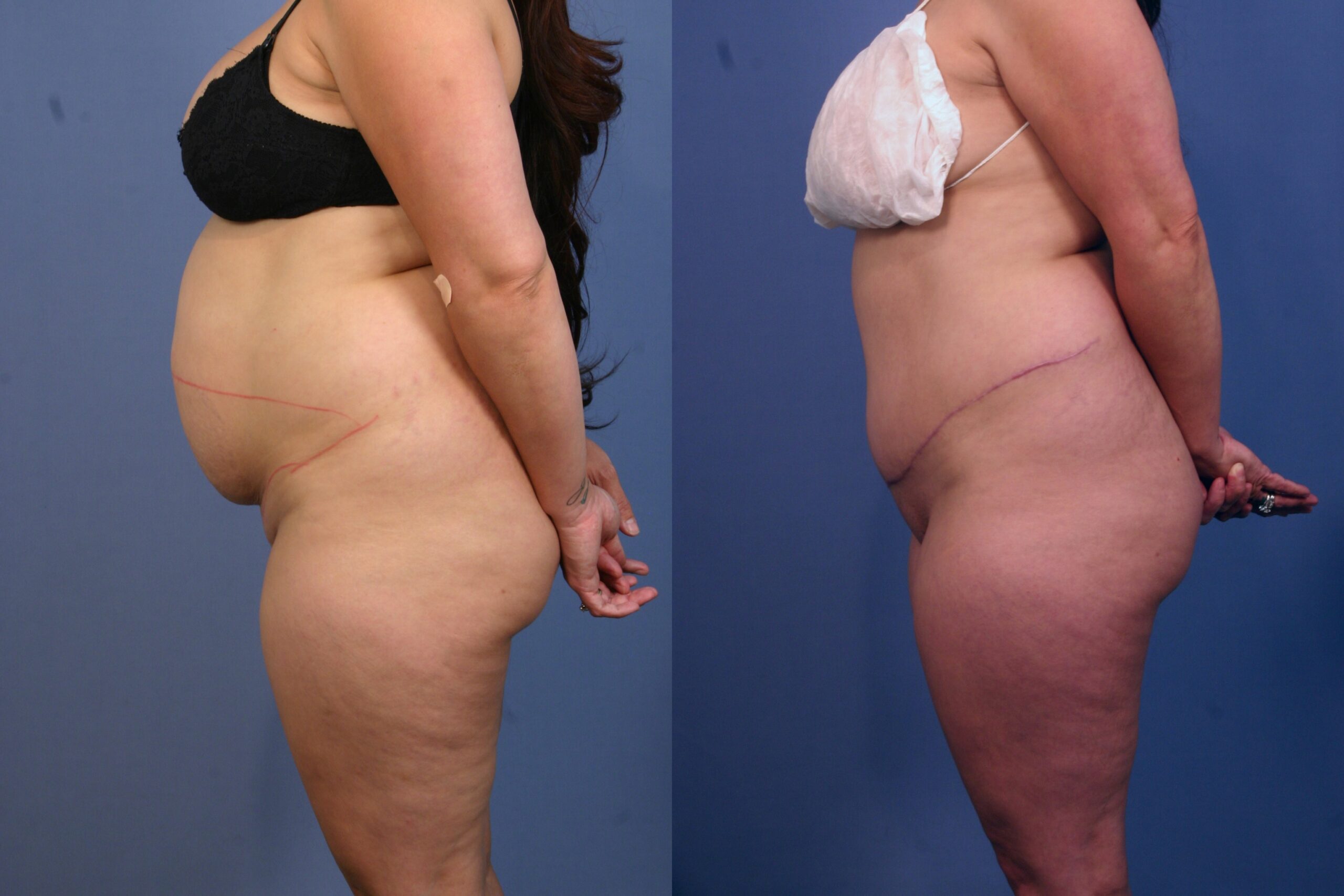 Tummy-Tuck-patient-15 | Before and After Tummy Tuck
