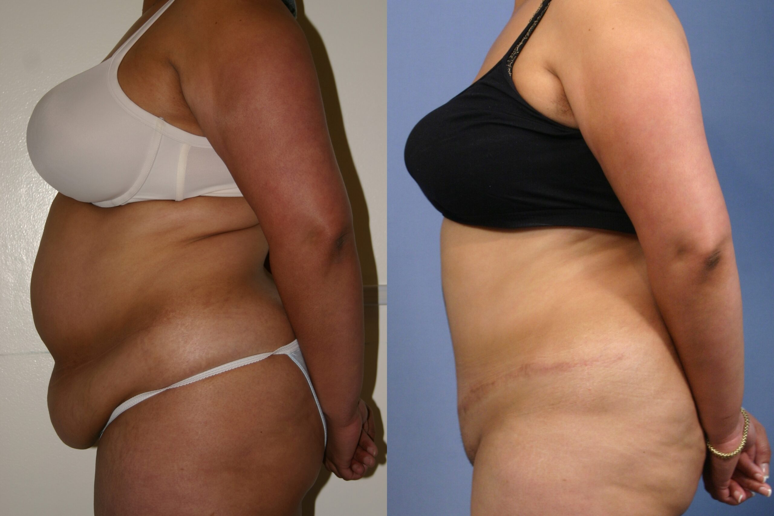 Tummy-Tuck-patient-16 | Before and After Tummy Tuck