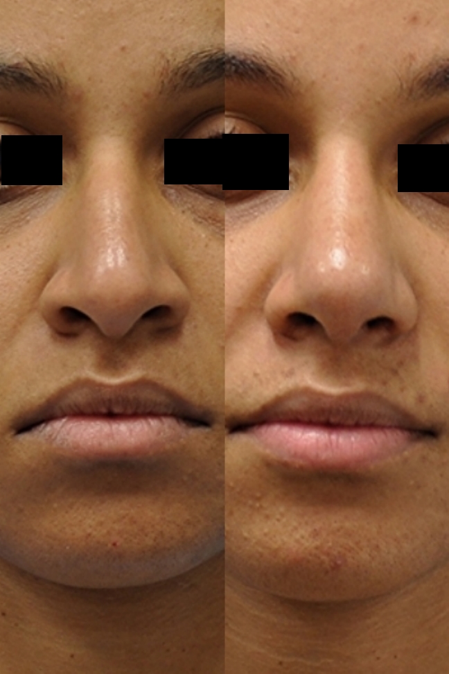 Case--1003 | Before and After Rhinoplasty