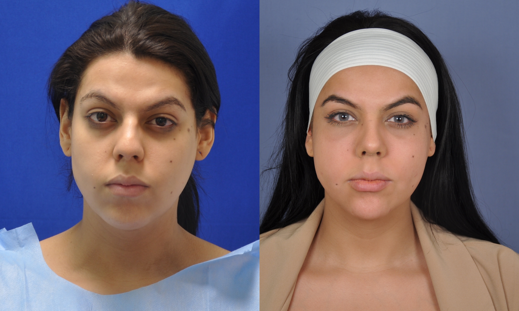 Case--4411 | Before and After Fat Transfer Face