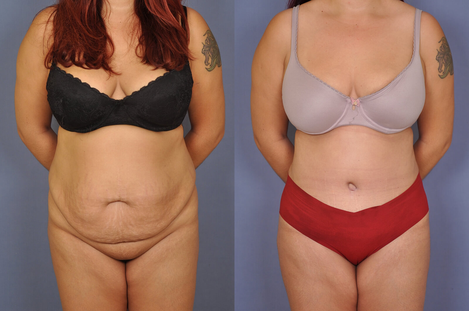 Case--1118 | Before and After Tummy Tuck