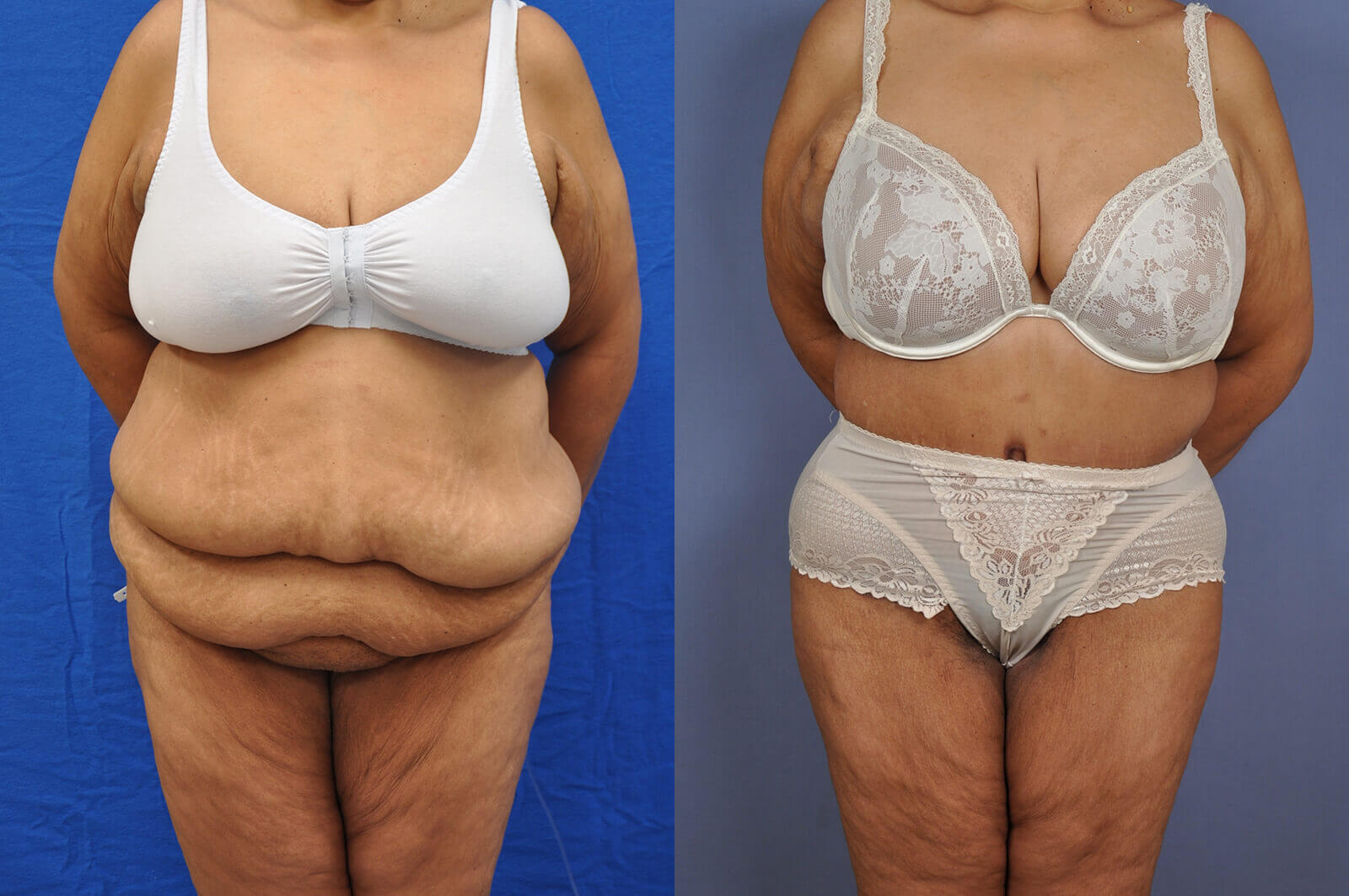 Case--1116 | Before and After Tummy Tuck
