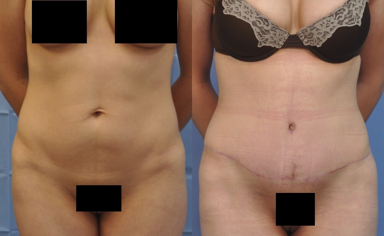 Case--1117 | Before and After Tummy Tuck