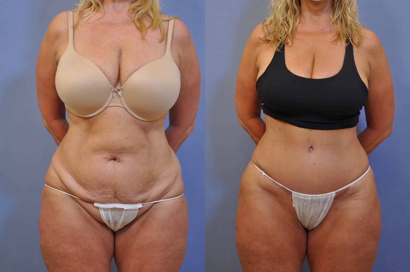 Case--1113 | Before and After Tummy Tuck