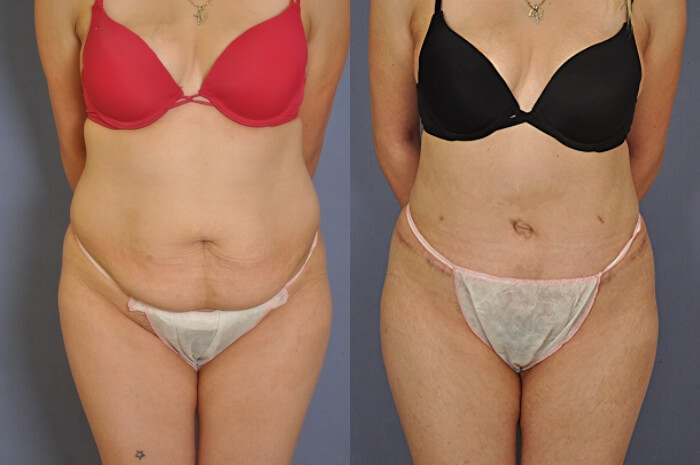 Case--1119 | Before and After Tummy Tuck