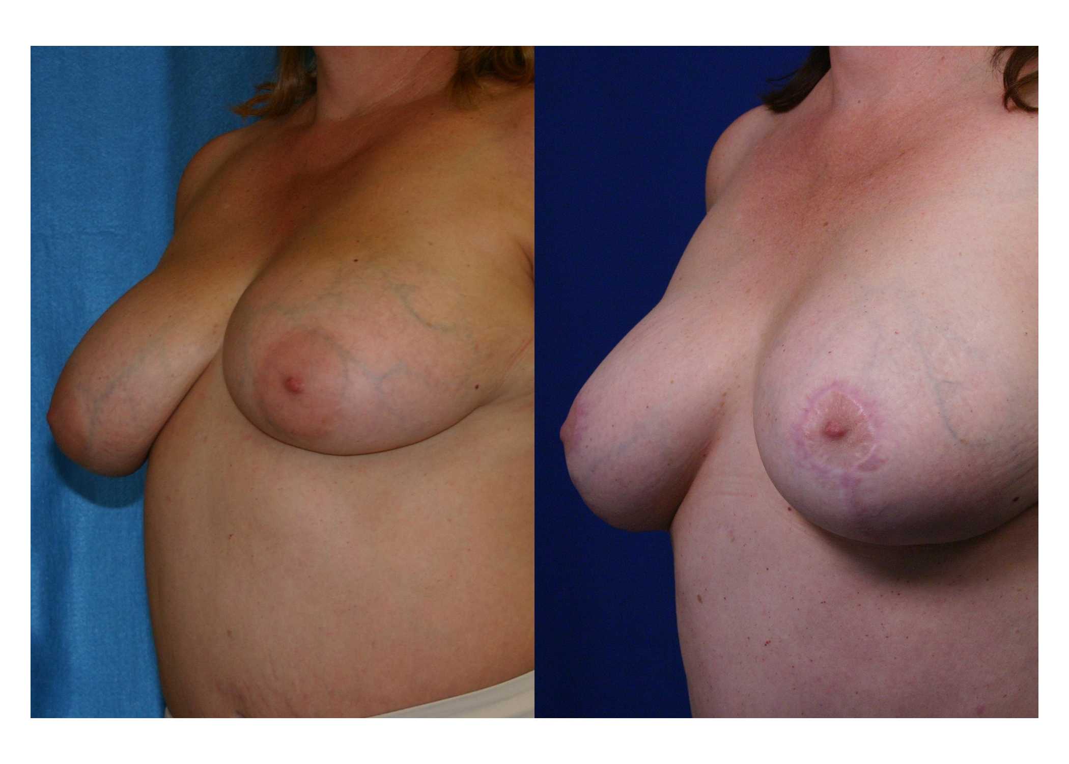 Breast-reduction-patient-04 | Before and After Breast Reduction