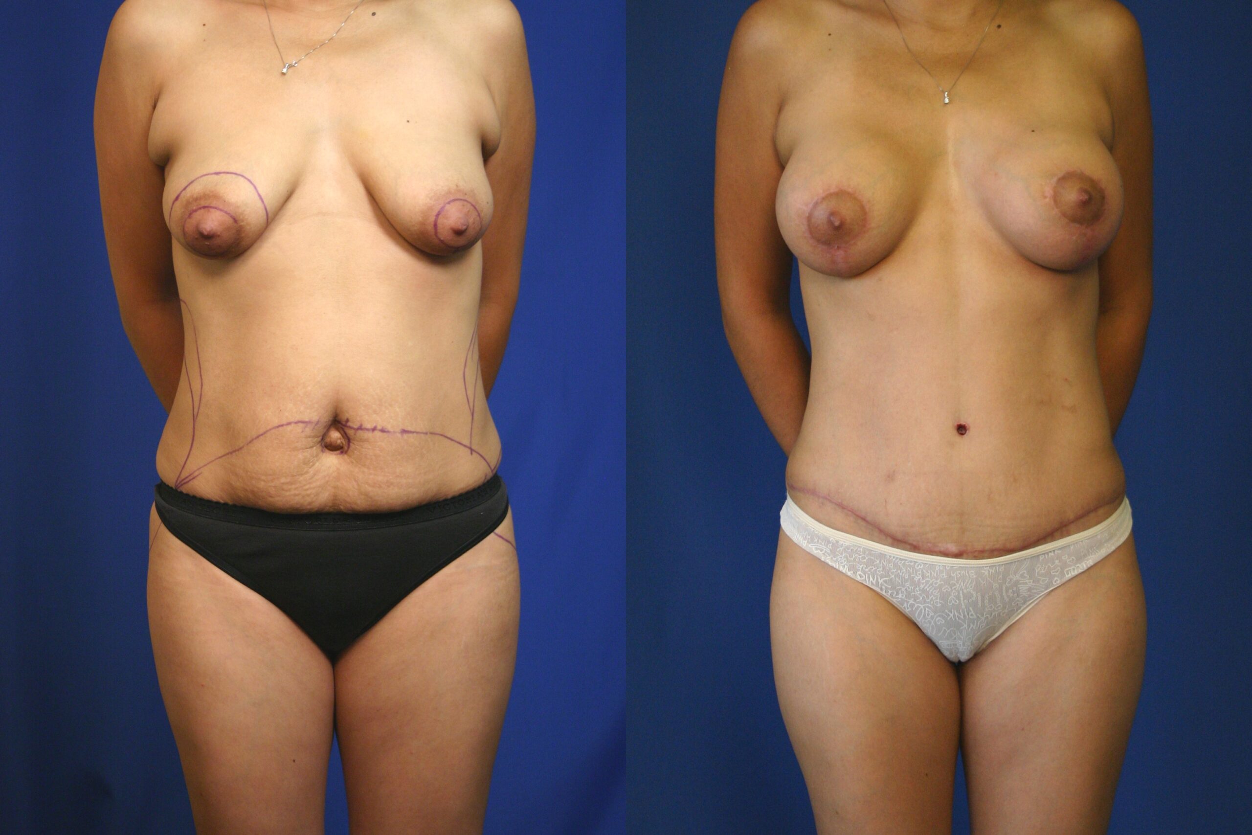 Case--2034 | Before and After Mommy Makeover