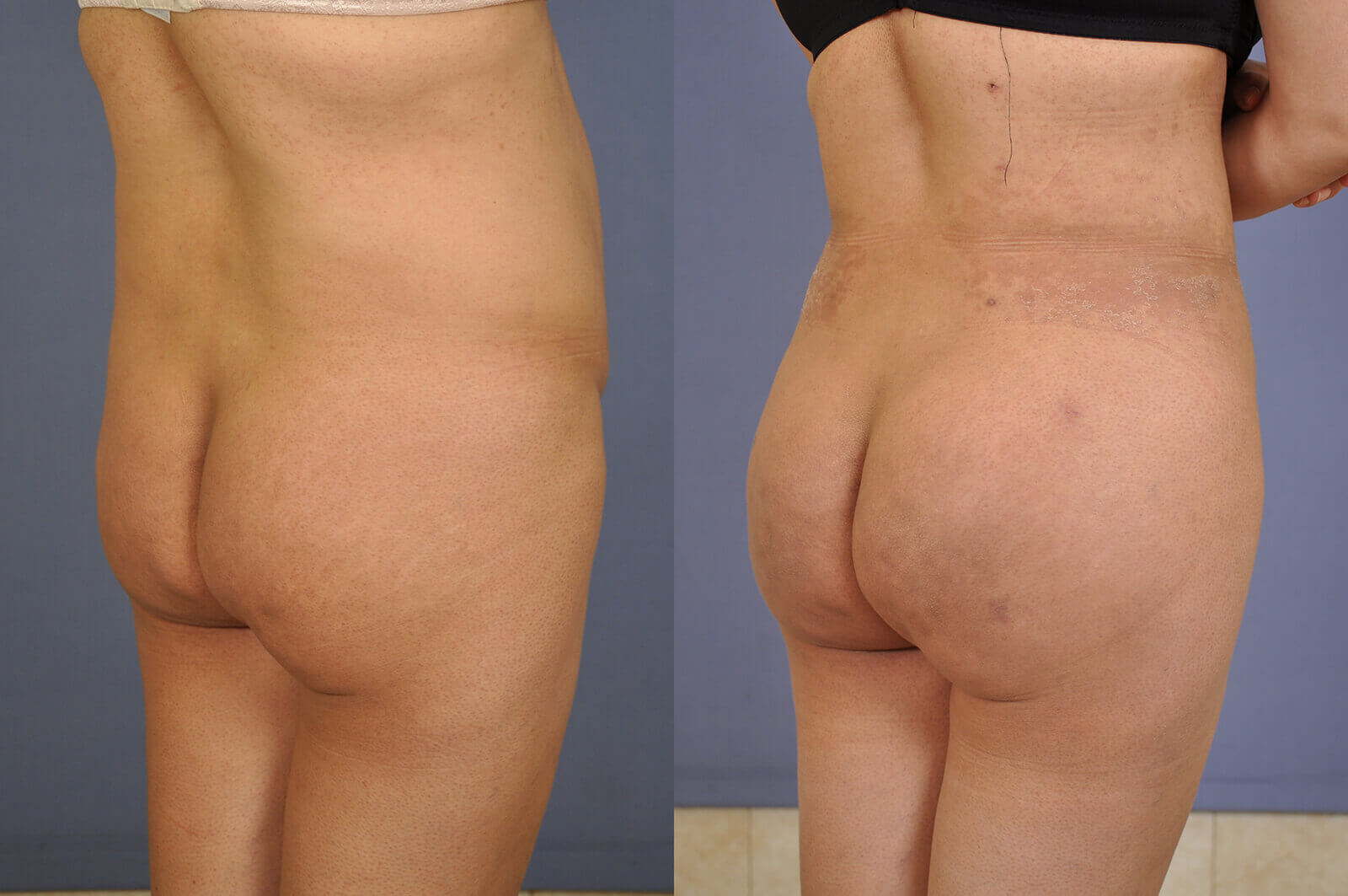 Case--0133 | Before and After Brazilian Butt Lift