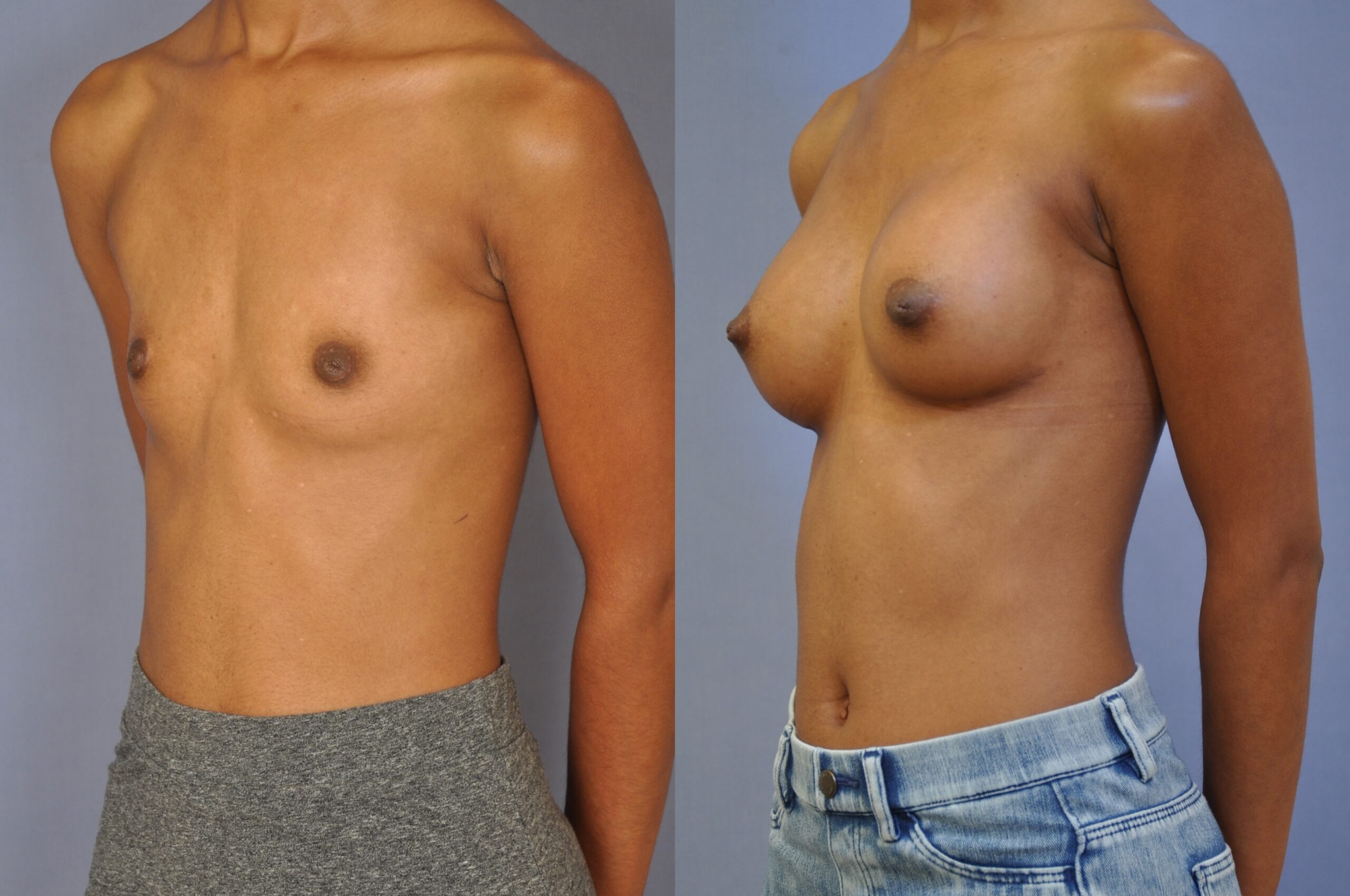 Breast-Augmentation-11 | Before and After Breast Augmentation