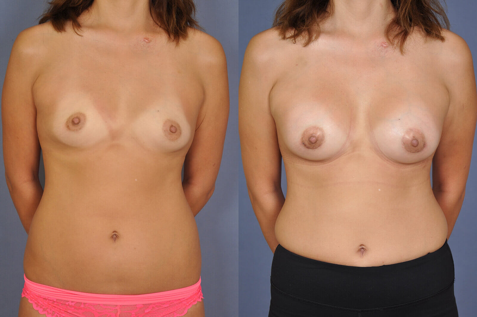 Case--5004 | Before and After Breast Augmentation
