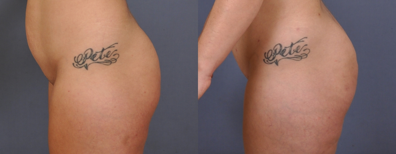 Case--0141 | Before and After Brazilian Butt Lift