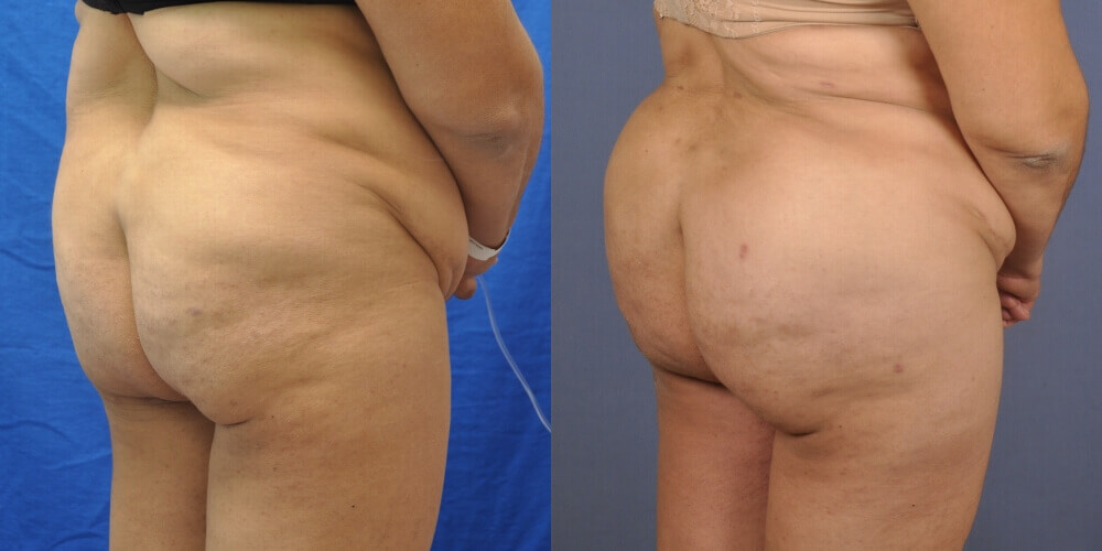 Case--0140 | Before and After Brazilian Butt Lift